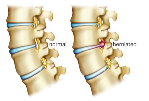 Treating Herniated Spinal Disks